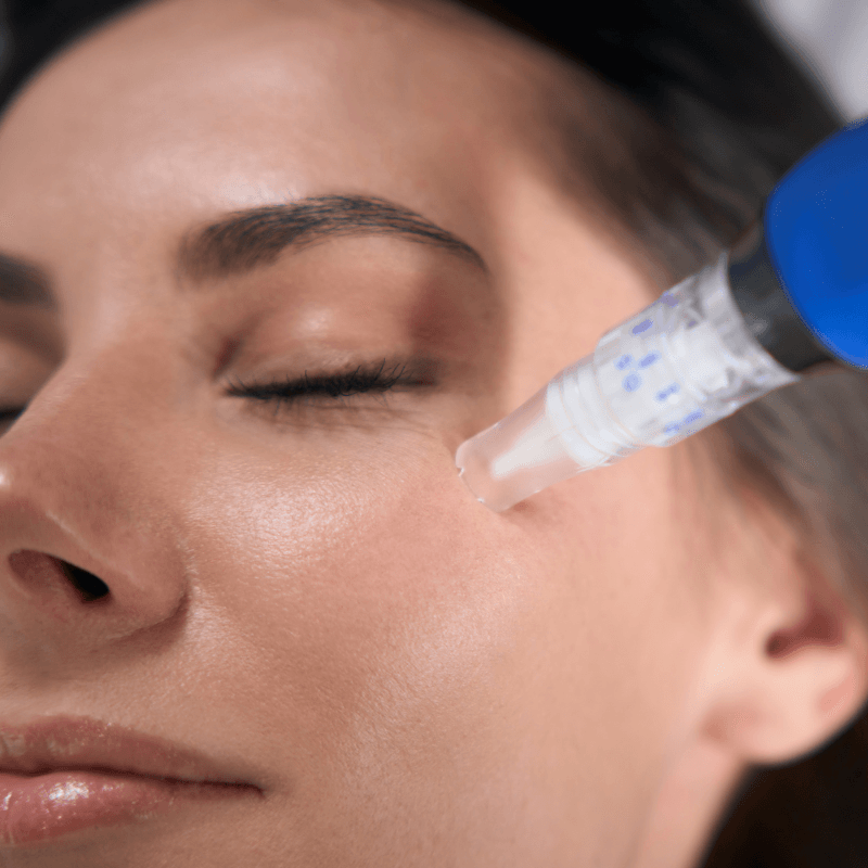 skinpen microneedling details at SafiraMD